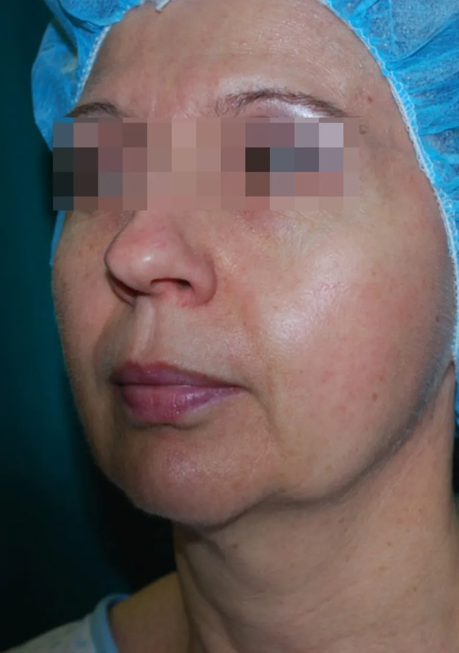 Брыли до процедуры Morpheus8 и FaceTite