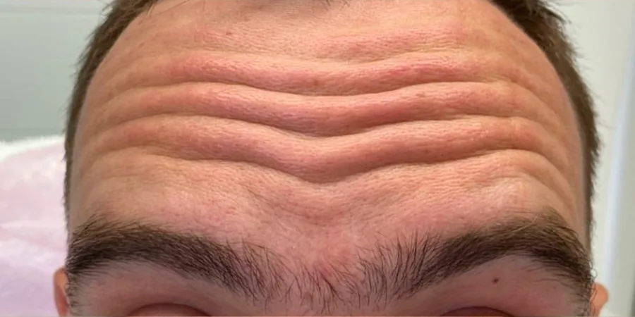 До процедуры