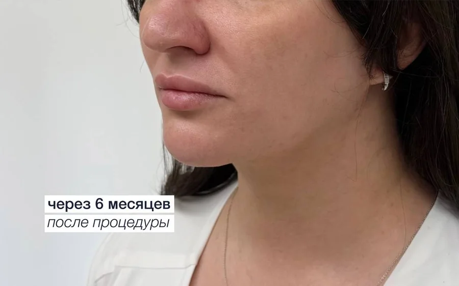 После процедуры