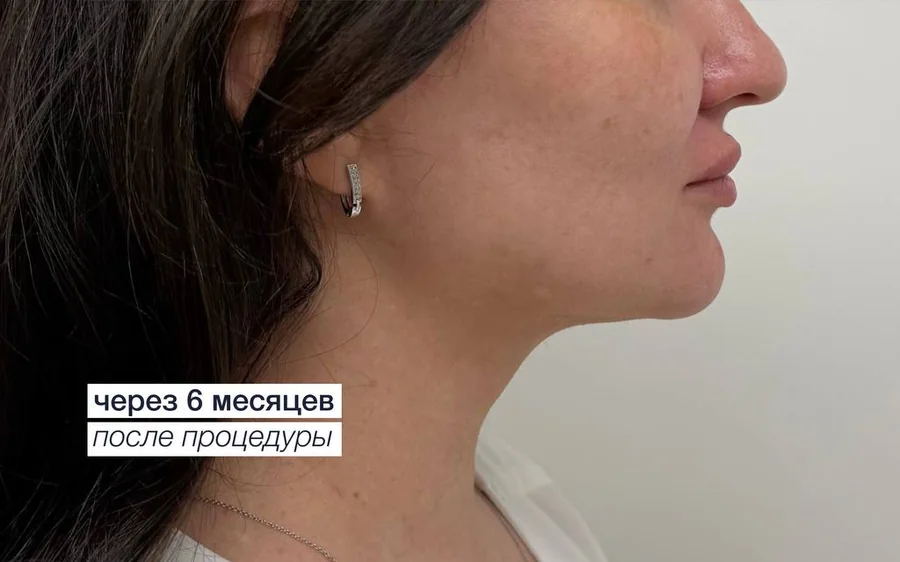 После процедуры